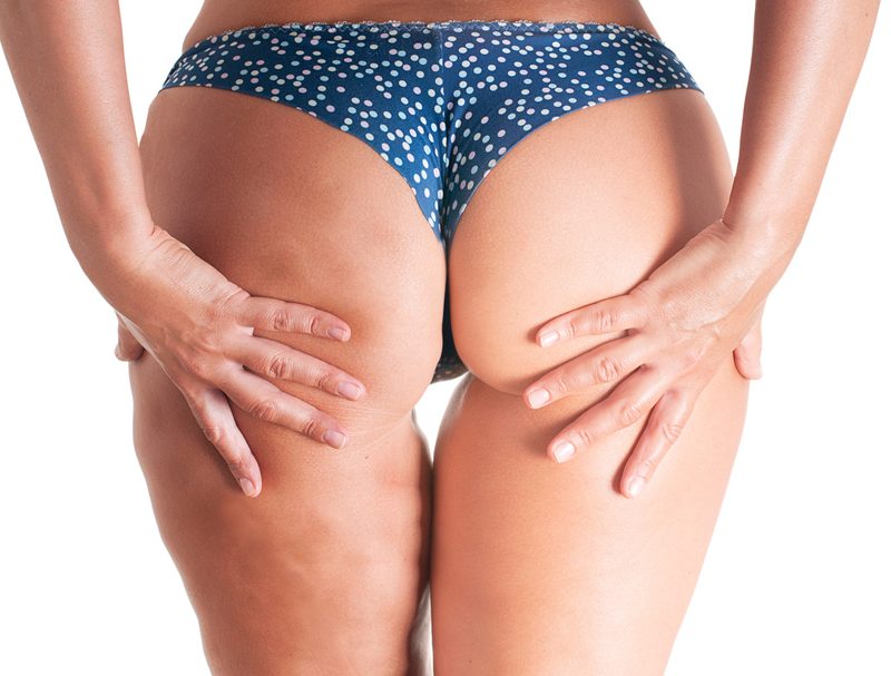 Eliminar la celulitis-Tratamiento Liposucción Zaragoza
