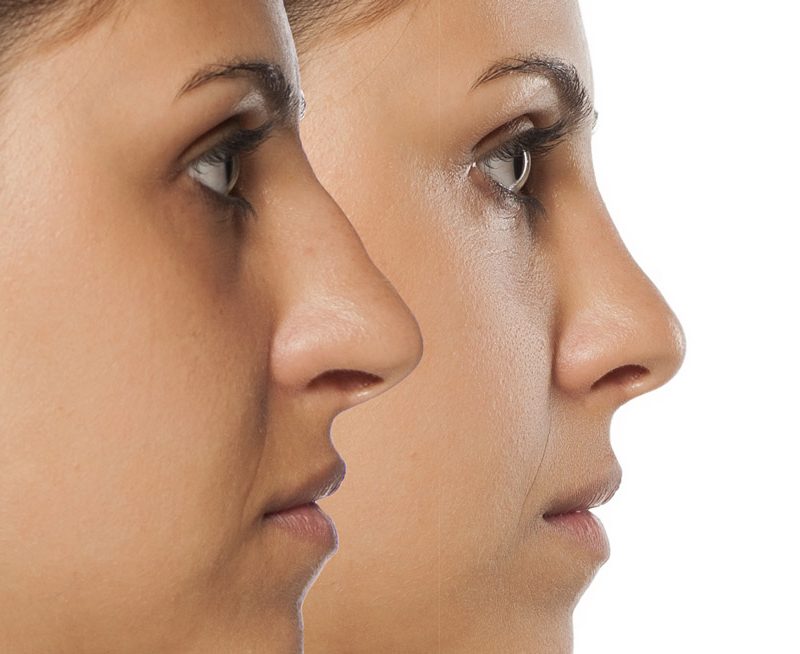 rinoplastia-conchita-zaragoza