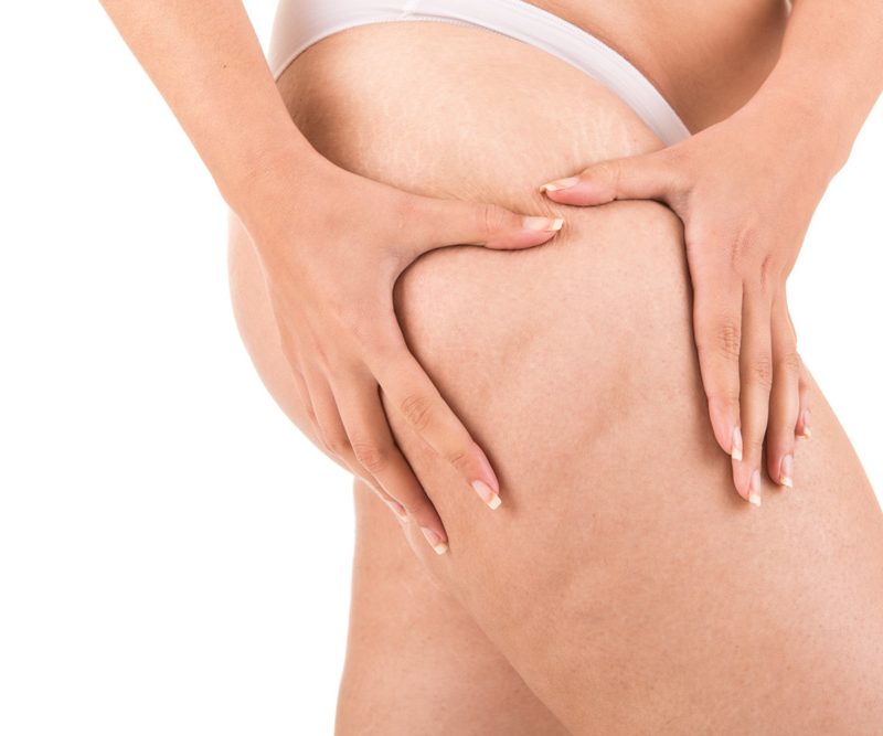 celulitis-piernas