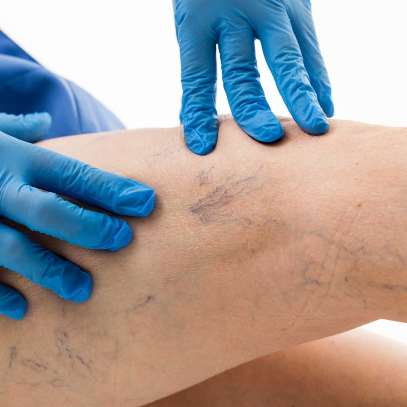 eliminar-varices