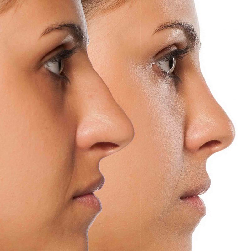 rinoplastia