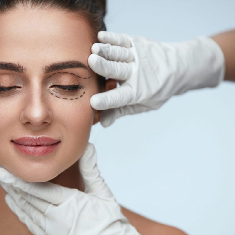 Blefaroplastia-marcas-contorno