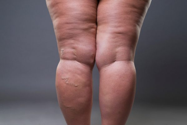 Lipedema-hinchazon-piernas