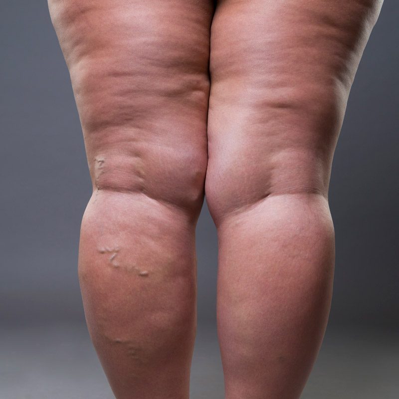 Lipedema-hinchazon-piernas